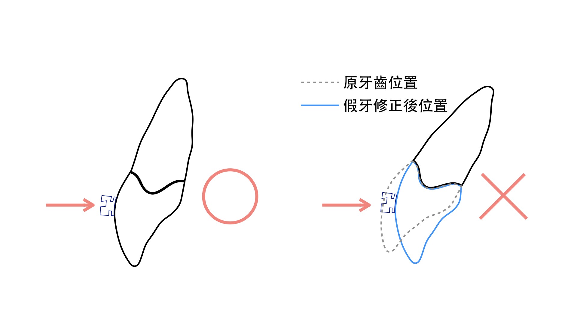 矯正前要注意牙齒什麼問題呢？ PART II調整牙齒型態、大小、軸向